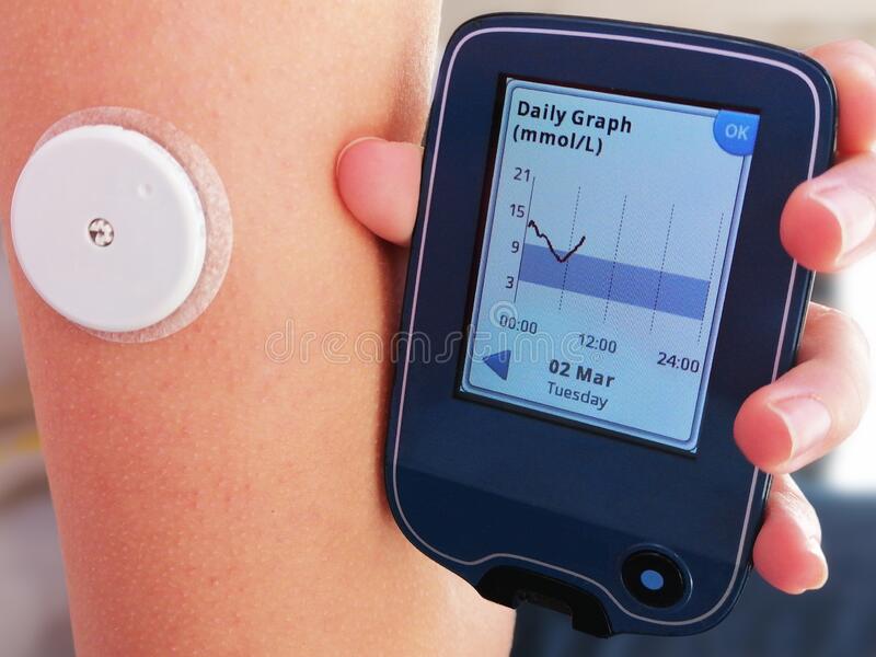 LA MESURE DU GLUCOSE EN CONTINU (CGM) EST EFFICIENTE DANS LE DT1 : UNE ÉTUDE COÛT/EFFICACITÉ